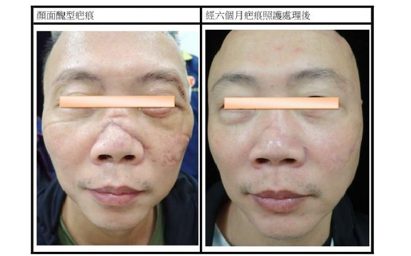 閨女要出嫁 老爸除疤「顧面子」
