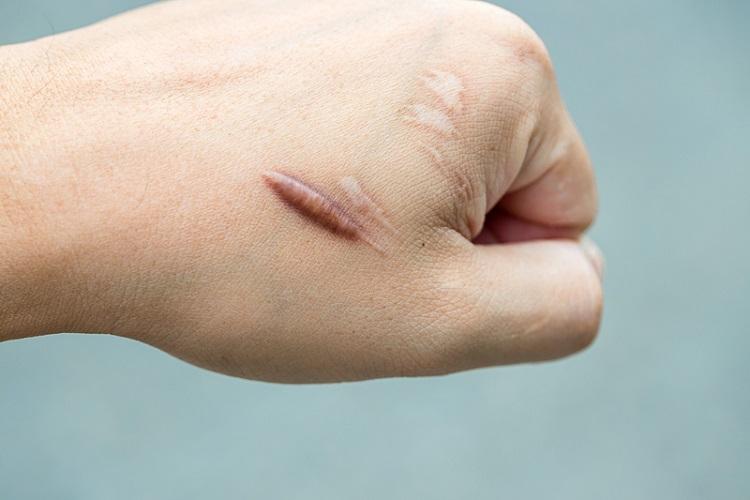 受傷如何避免留疤？ 整形外科教「傷口3階段照顧SOP」