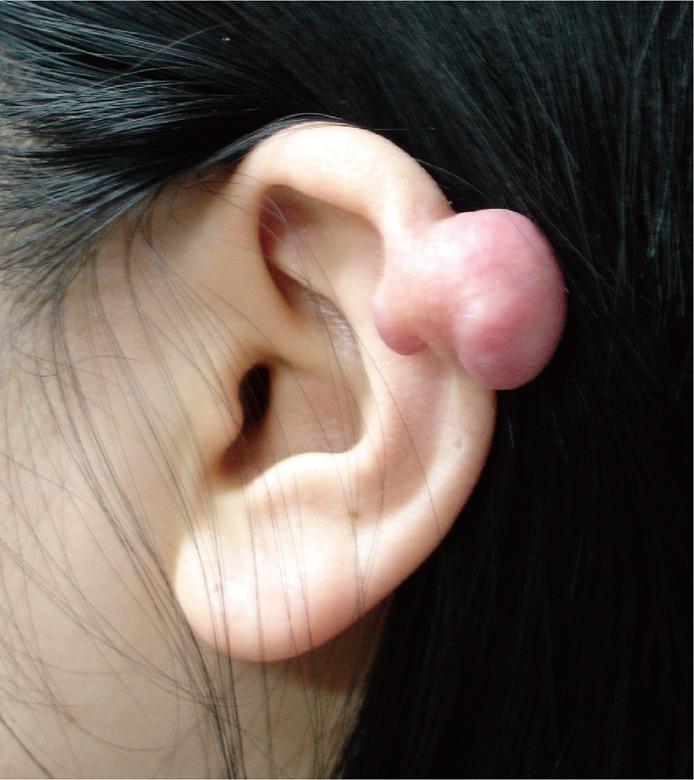 耳朵蟹足腫處理